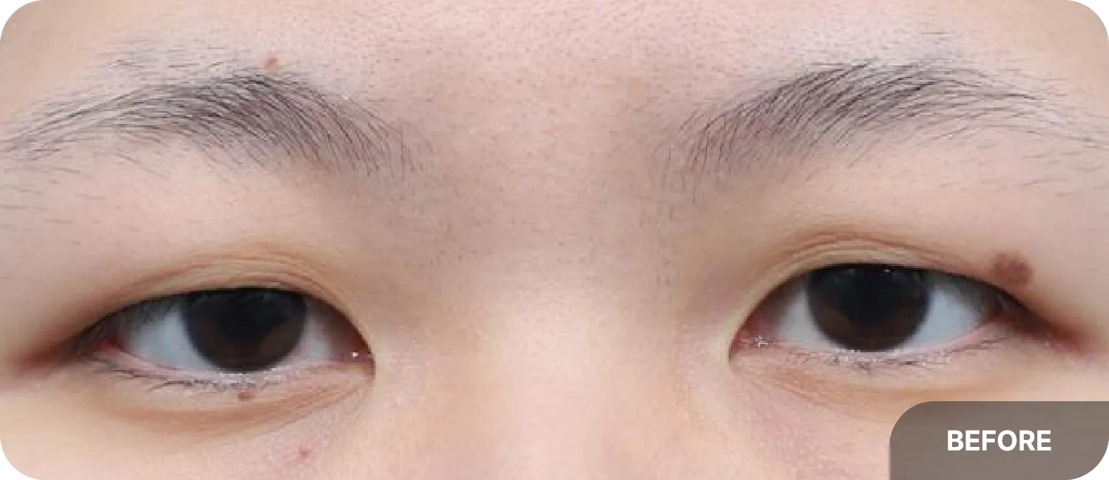 Before double crease surgery - upper eyelid hooding and reduced eye definition