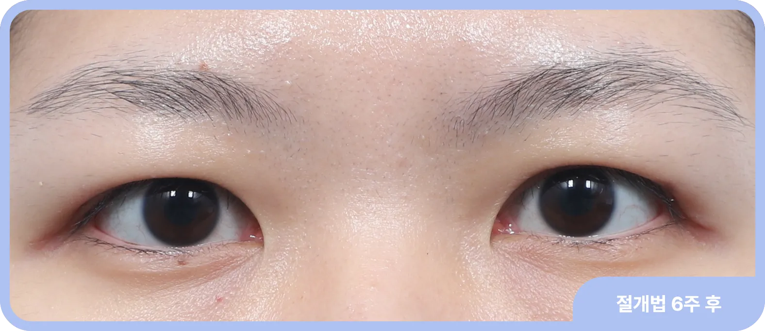 인라인 쌍꺼풀 수술 - 자연스럽고 세련된 눈매 구현
