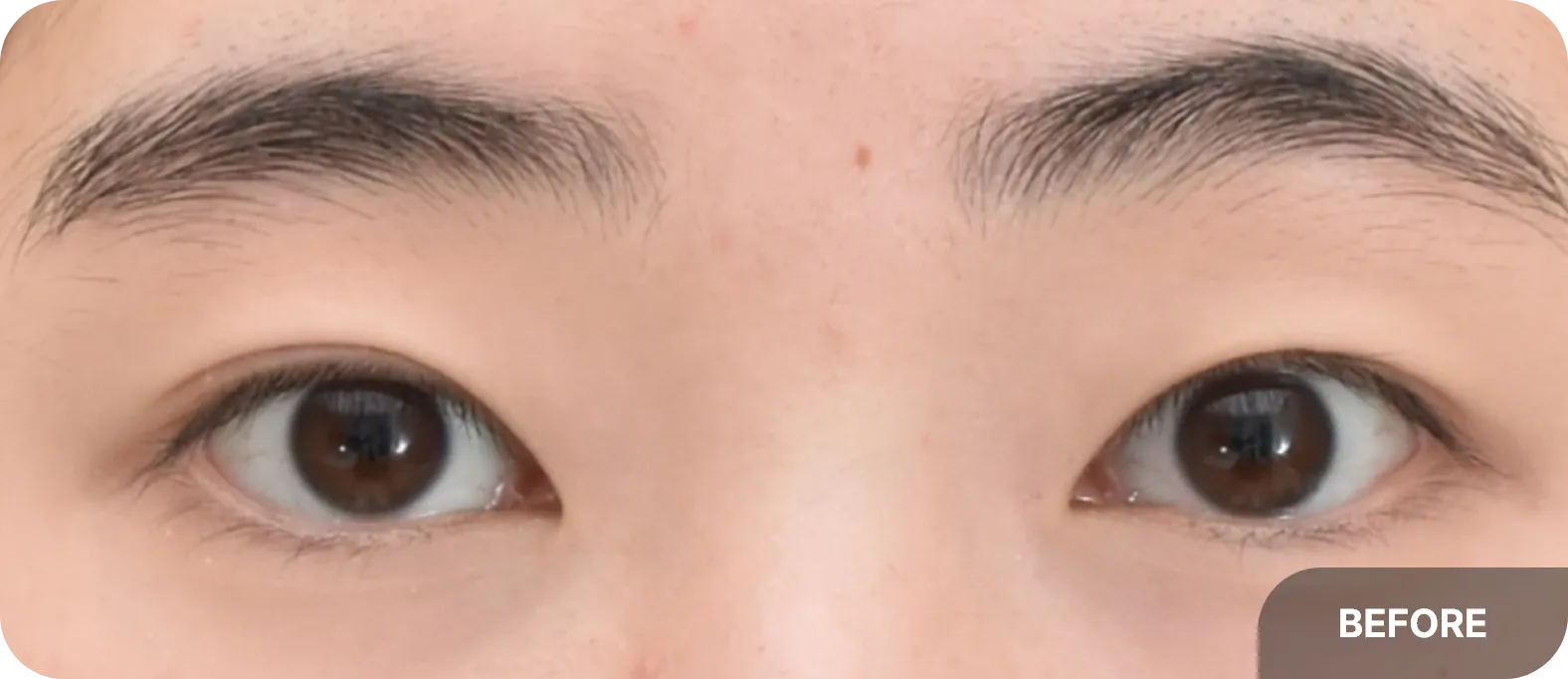 before eyelid surgery