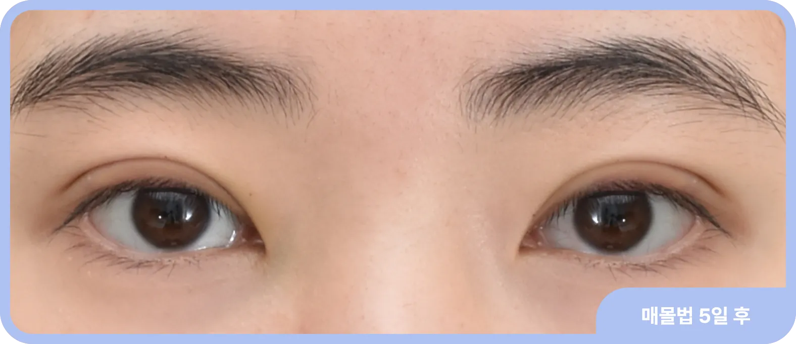 쌍수 매몰 5일 뒤에도 자연스러운 인아웃 라인