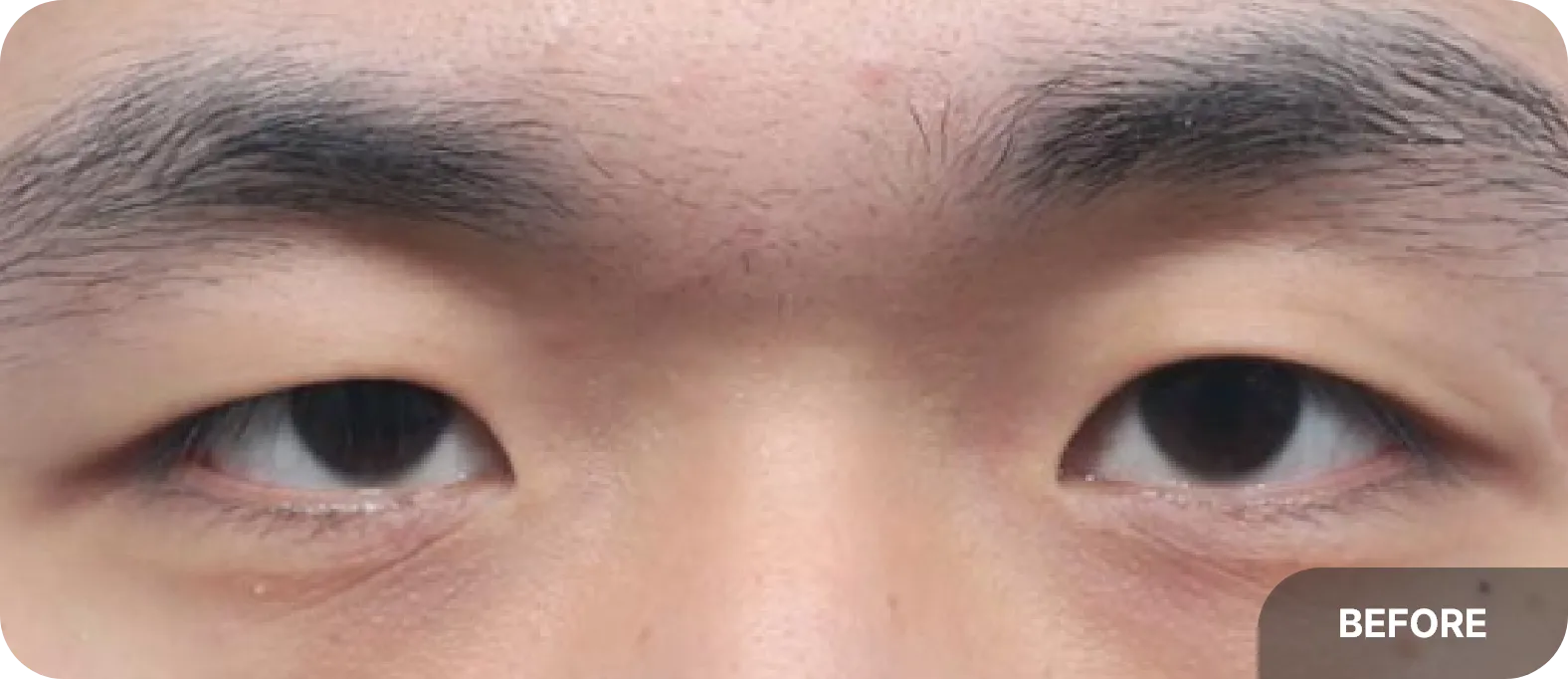 안검하수와 짝눈을 가진 30대 수술 전 모습