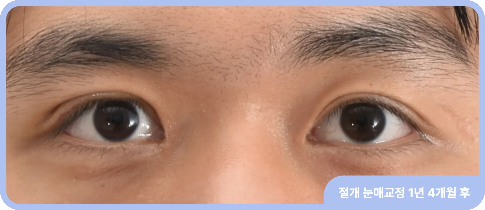 인아웃라인 쌍꺼풀 수술 - 눈의 크기와 깊이를 동시에 개선