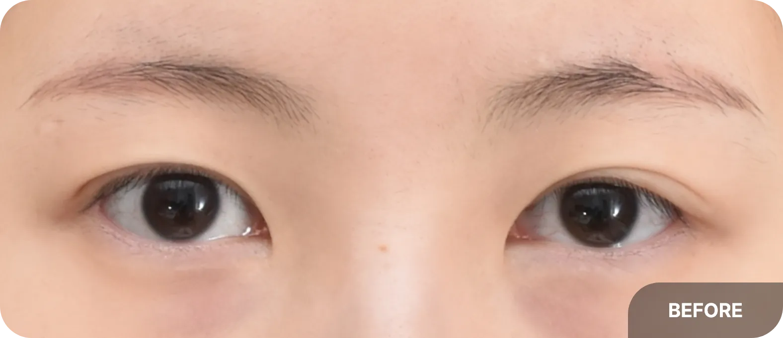 Asymmetric double eyelid crease