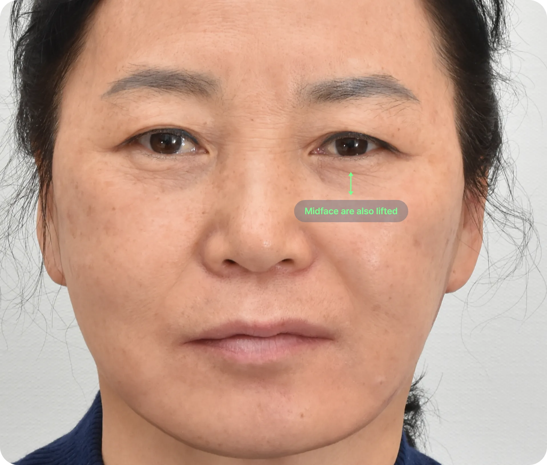 Post-facelift surgery - rejuvenated, youthful face with smooth jowls contours