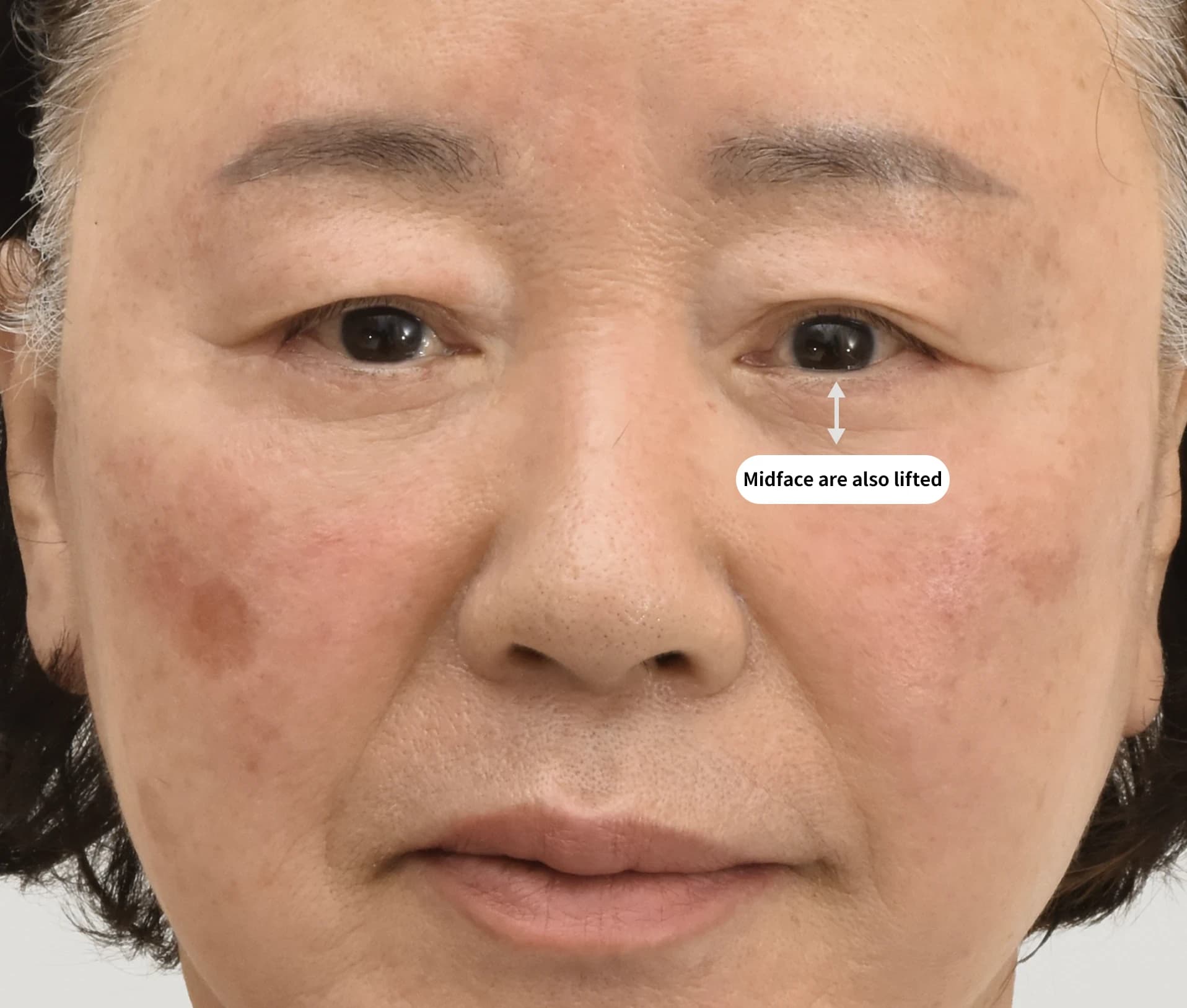 Post-facelift surgery - rejuvenated, youthful face with smooth jowls contours