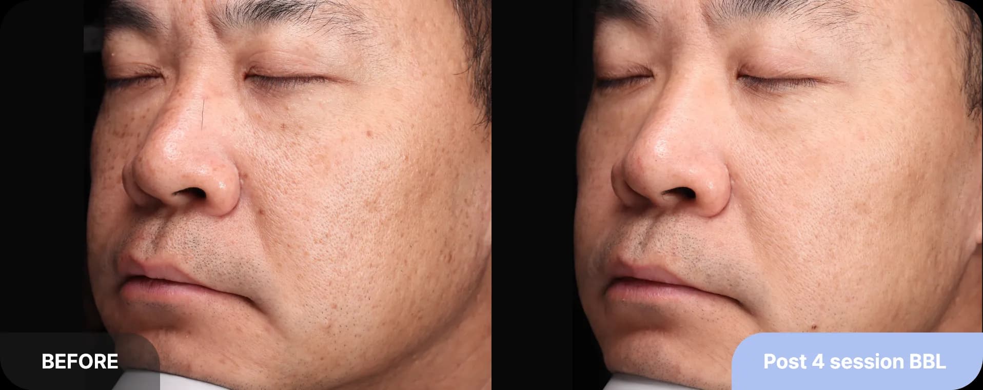 기미잡티레이저