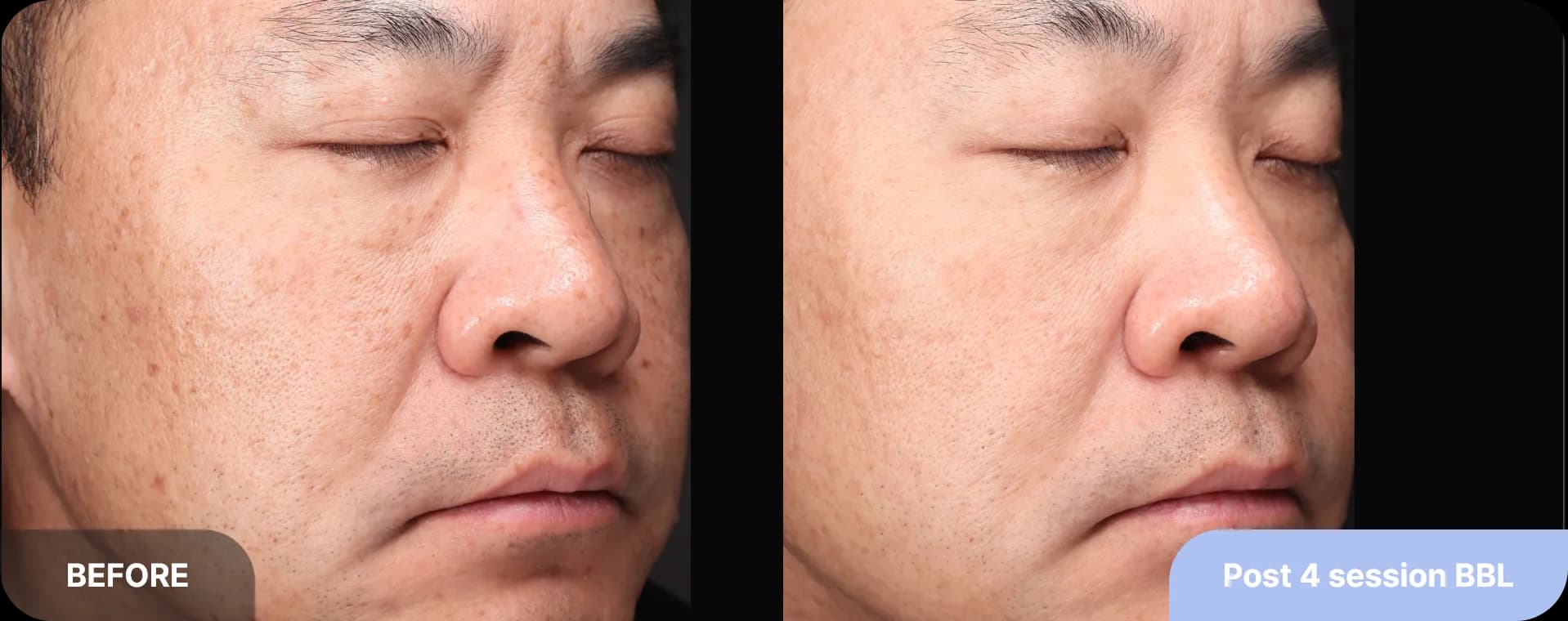 기미잡티레이저