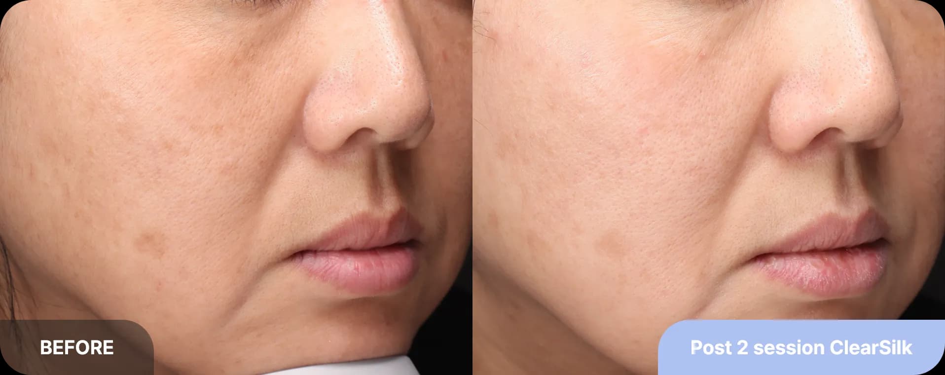 기미-토닝-레이저