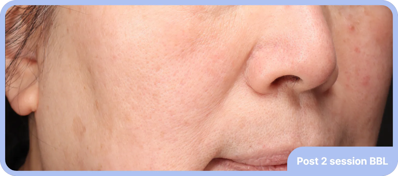 After BBL treatment for facial redness - smoother, more balanced skin tone