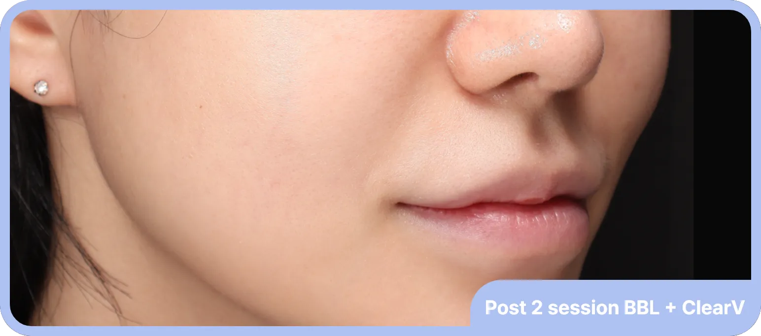 After BBL treatment for facial redness - smoother, more balanced skin tone
