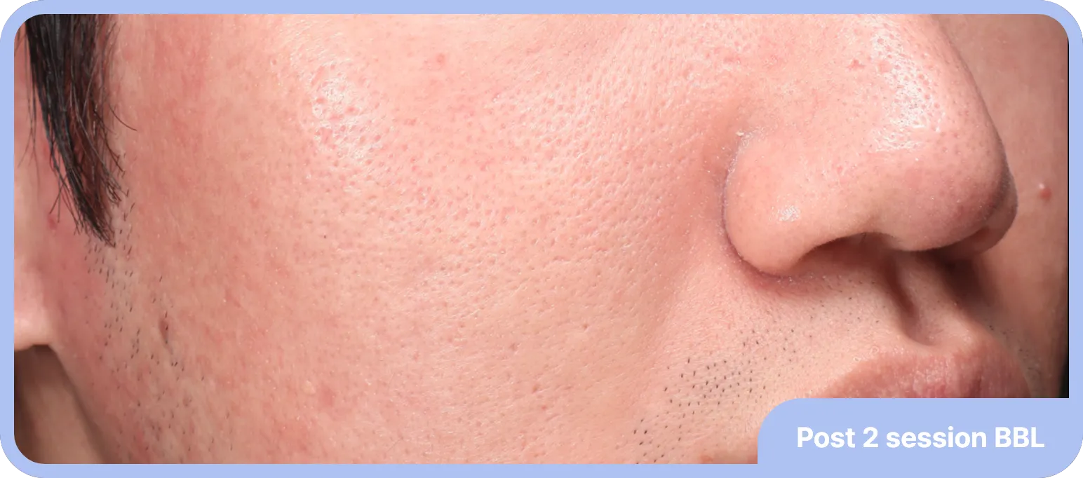 Before and after acne laser treatment