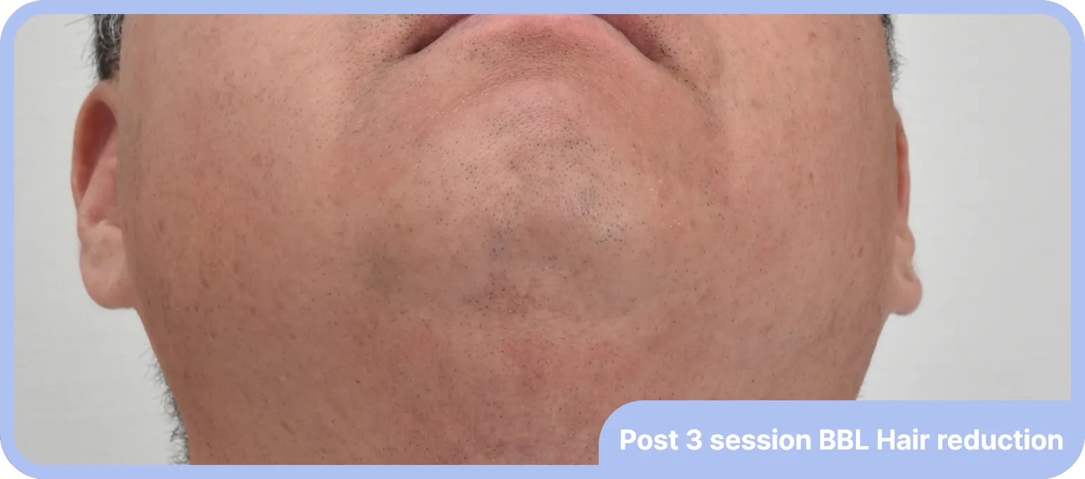 Before and after acne laser treatment
