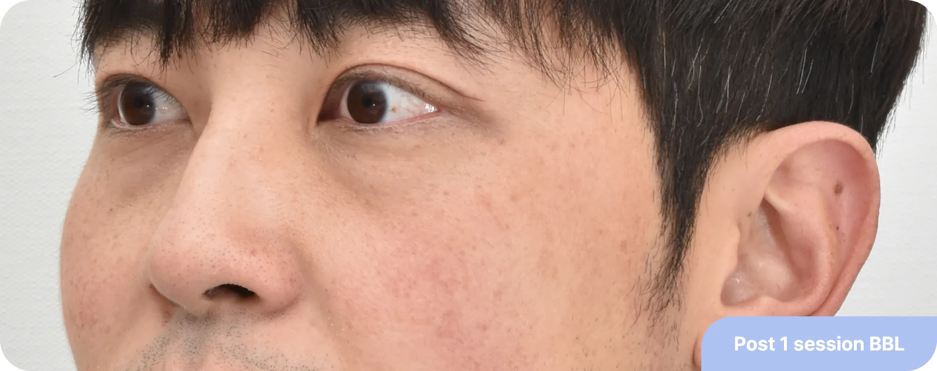 BBL-레이저-효과