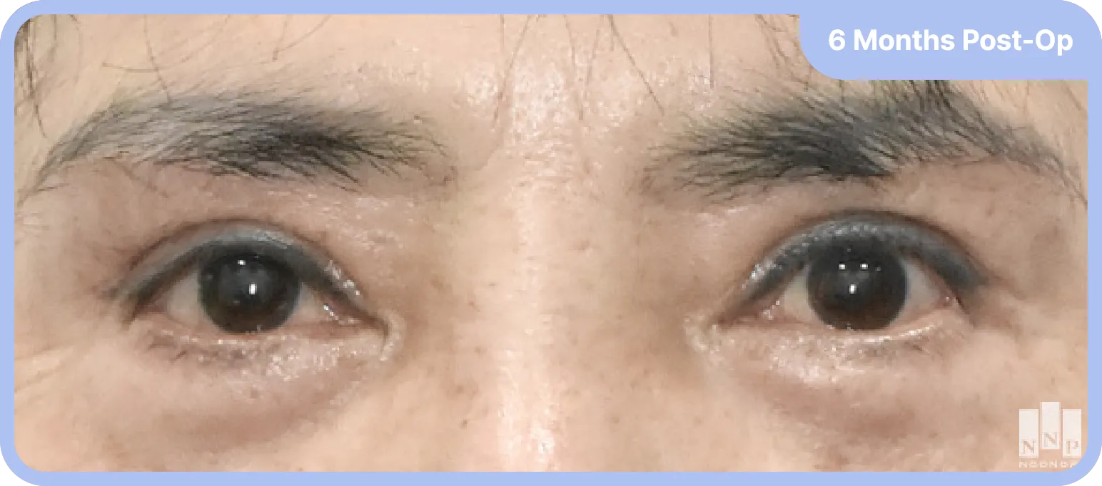 Results after infra brow lift - natural, defined eyebrows and a youthful expression