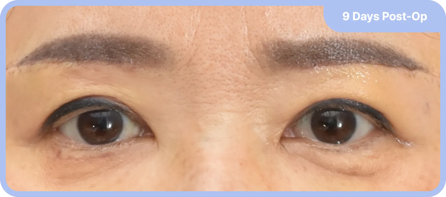 Post sub brow lift - lifted eyebrows and more youthful appearance