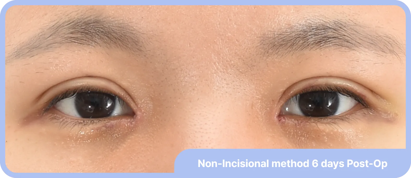 6 days after double eyelid surgery without incision - natural results and quick recovery