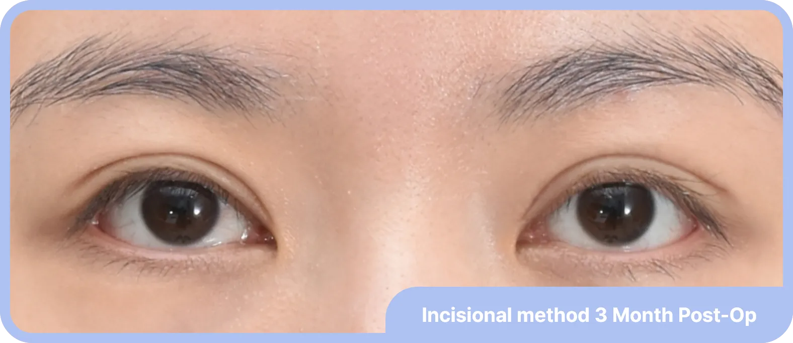 semi-out line after incisional double crease formation surgery