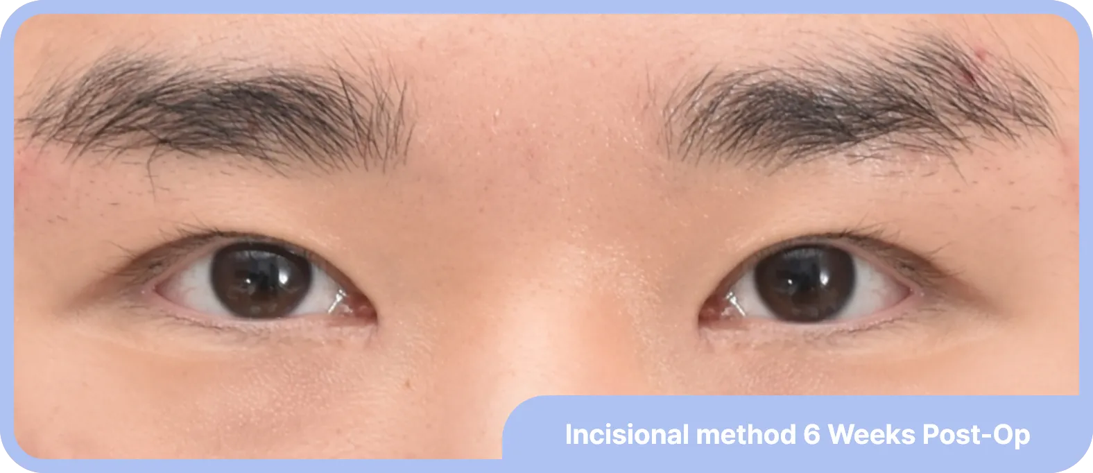 After double eyelid surgery for men - eyes appear larger and more defined