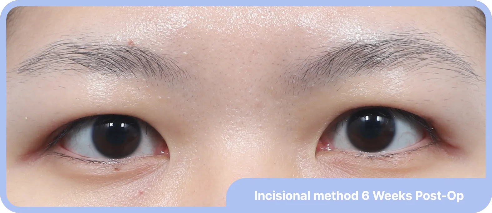 Double eyelid surgery post-Op - enlarged eyes and improved eye contour