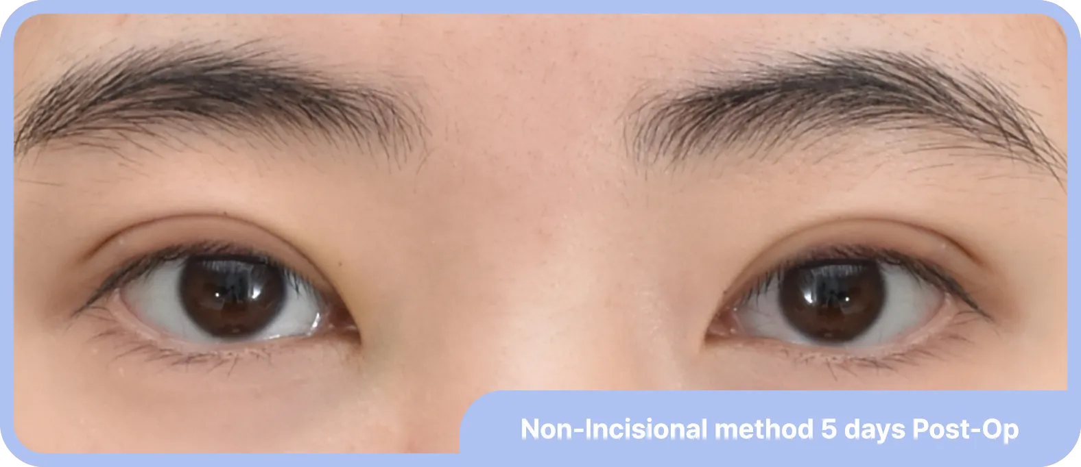 Non-incisional double eyelid surgery - achieving natural results with minimal recovery time, 5 days post-surgery