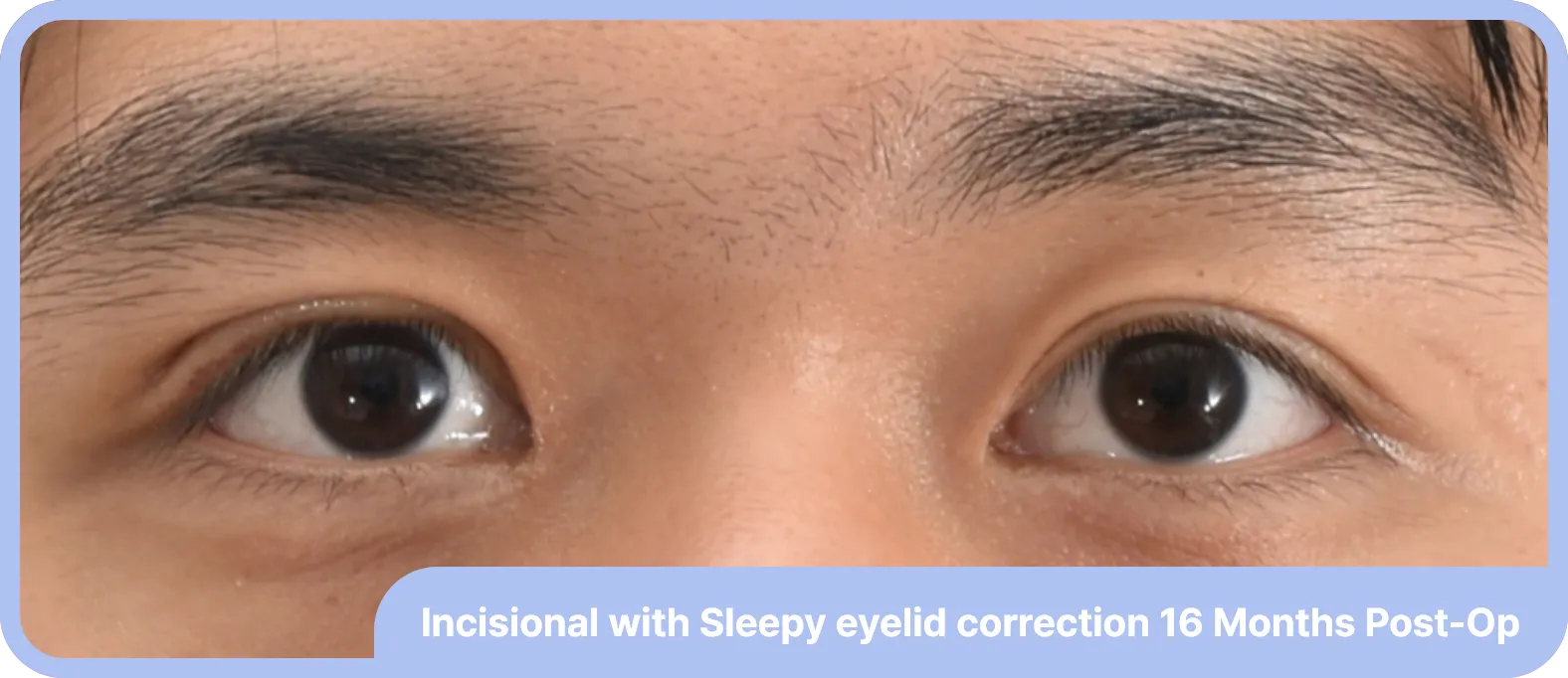 sleepy eyelid are treated with double eyelid surgery and ptosis correction