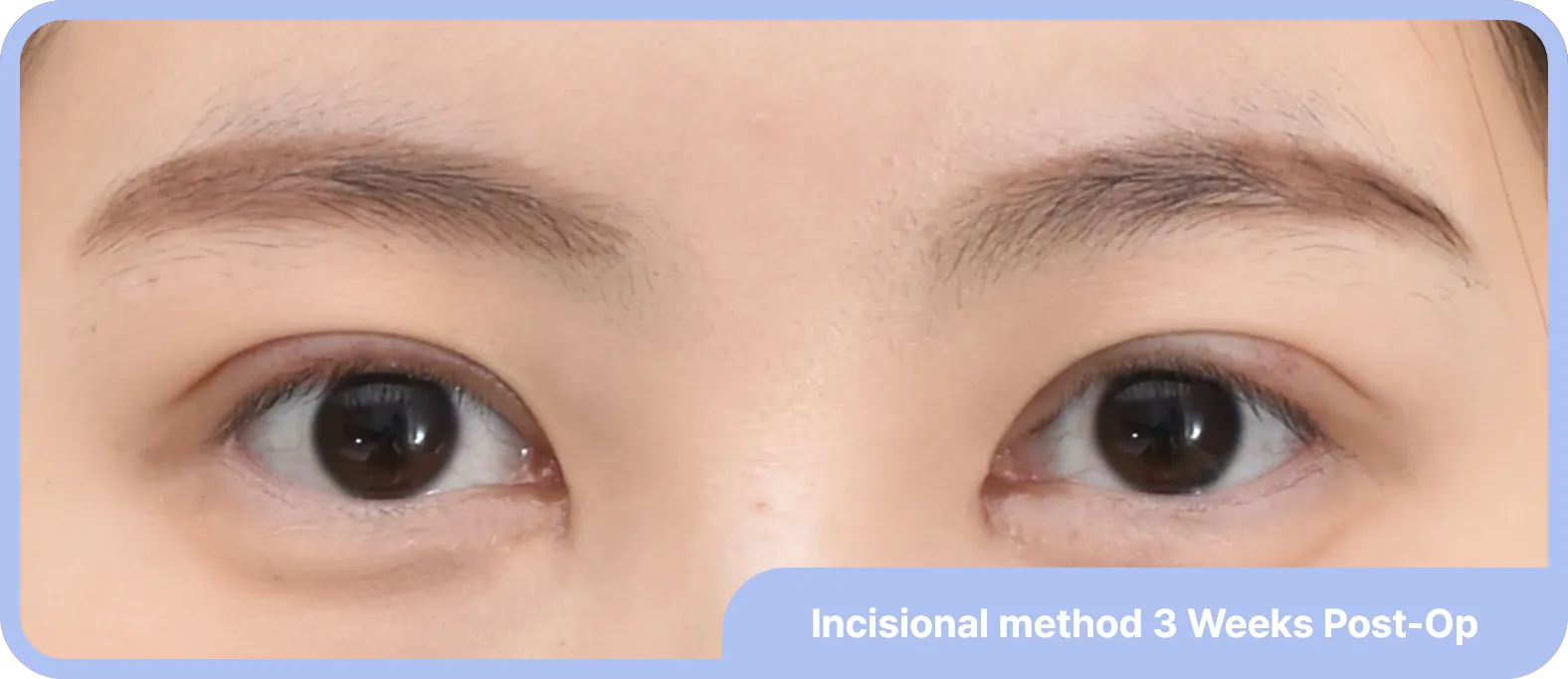 Double eyelid folds are well-tailored after surgery - natural and precise eyelid folds
