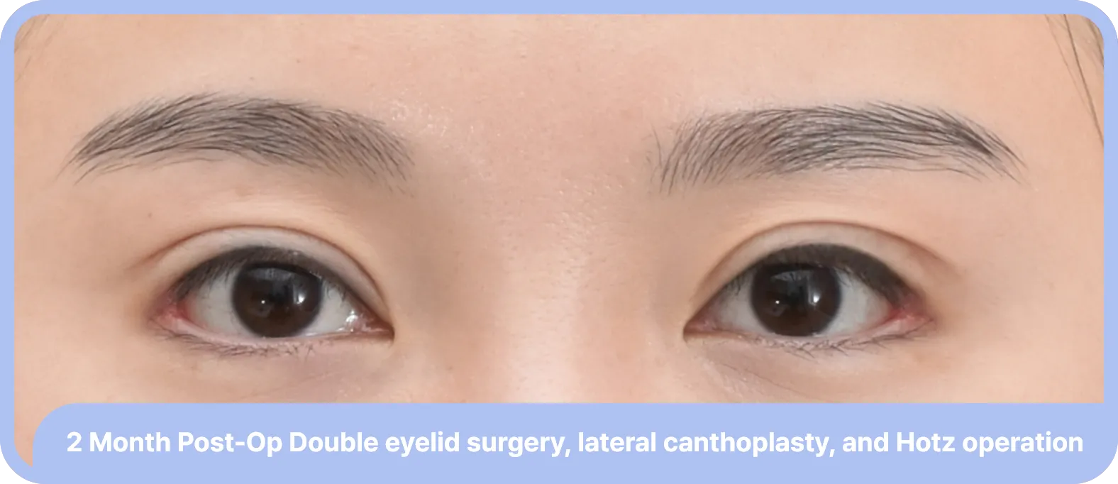 canthoplasty after
