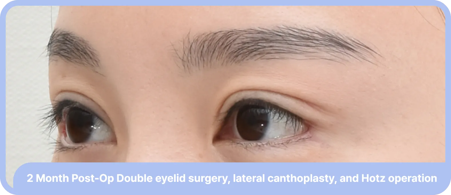 hotz procedure after