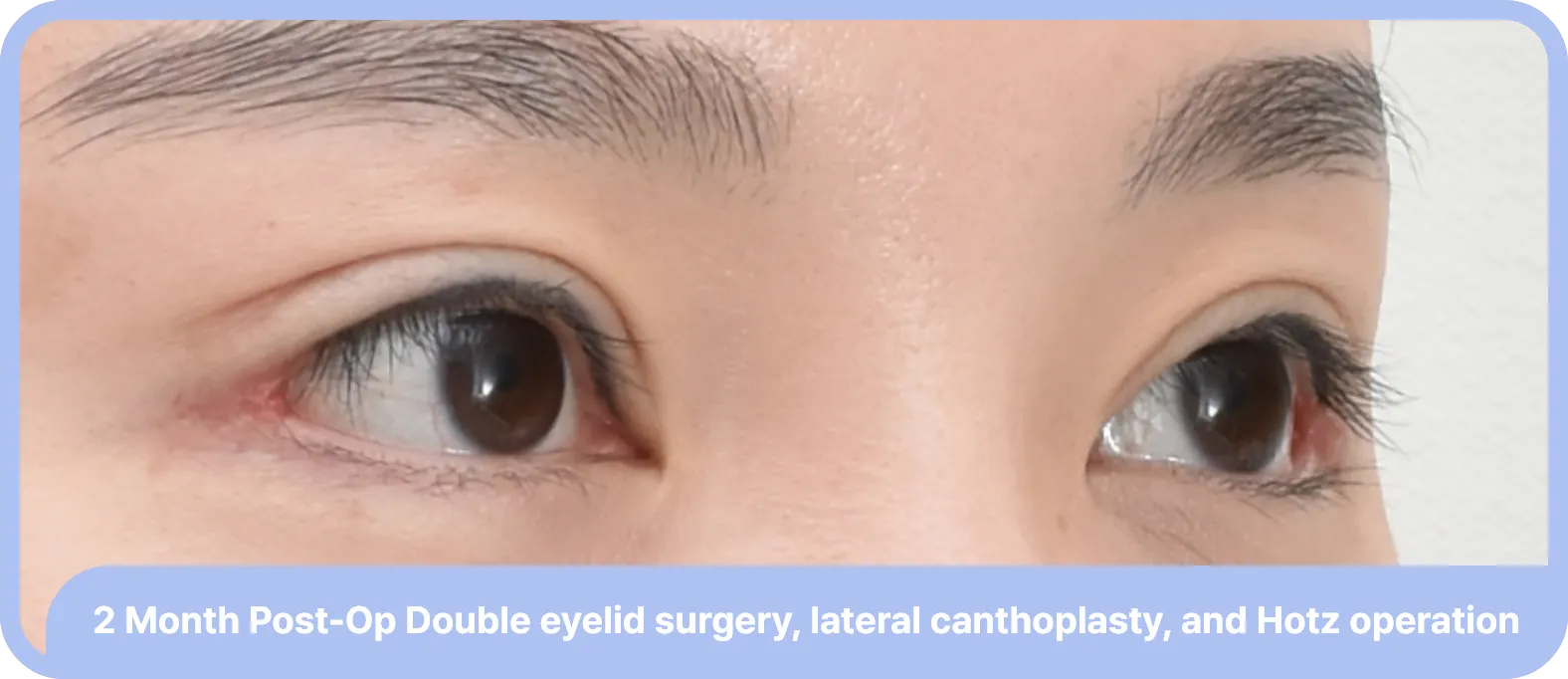 lateral canthoplasty after