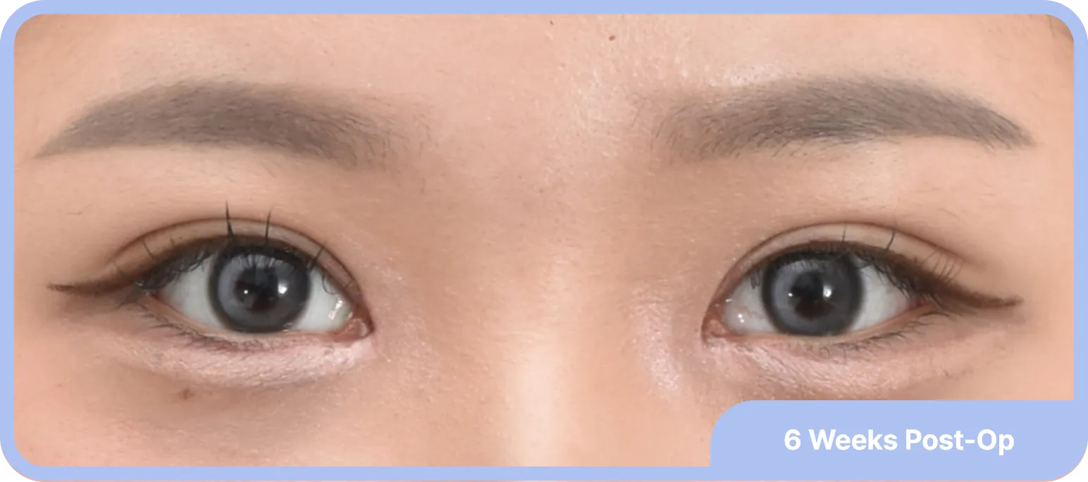 inner corner eyelid surgery after