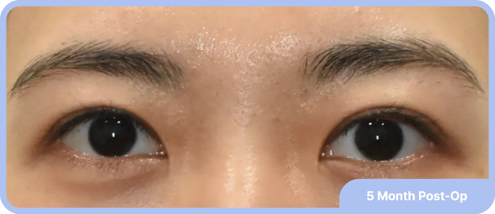 uneven eyes correction after