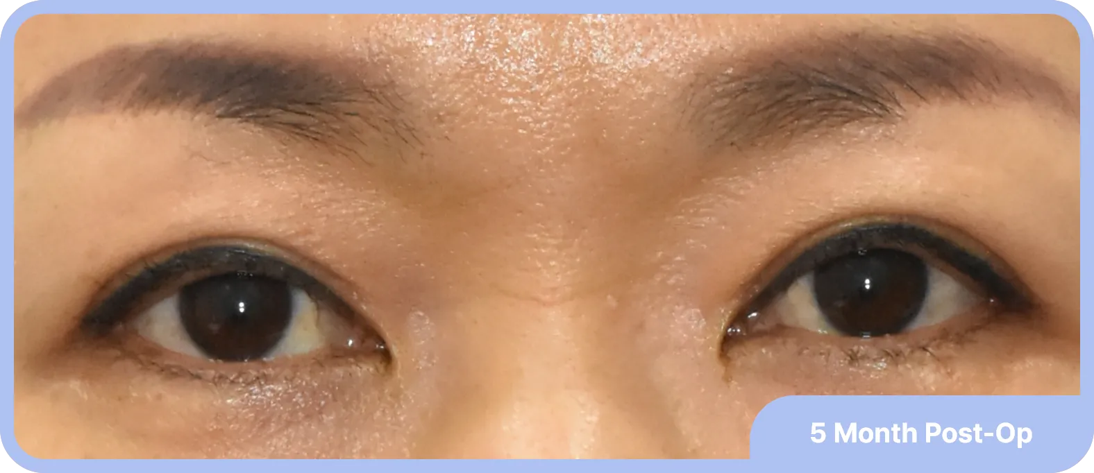 after double eyelid with ptosis surgery