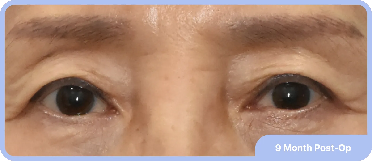 Sleepy looks are well treated with levator advancement surgery