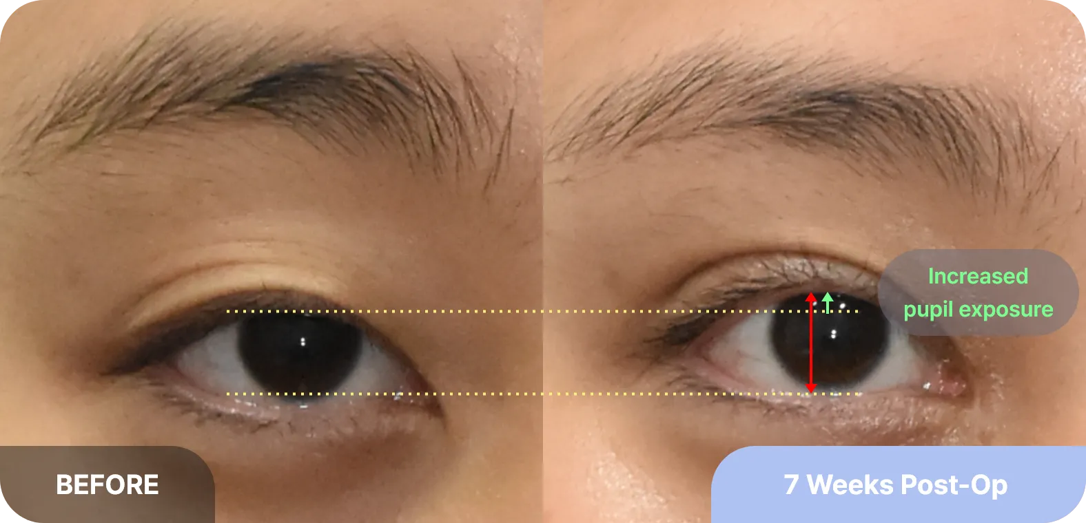 Ptosis surgery explained - fixing droopy eyelids by lifting and tightening the eye opening muscles