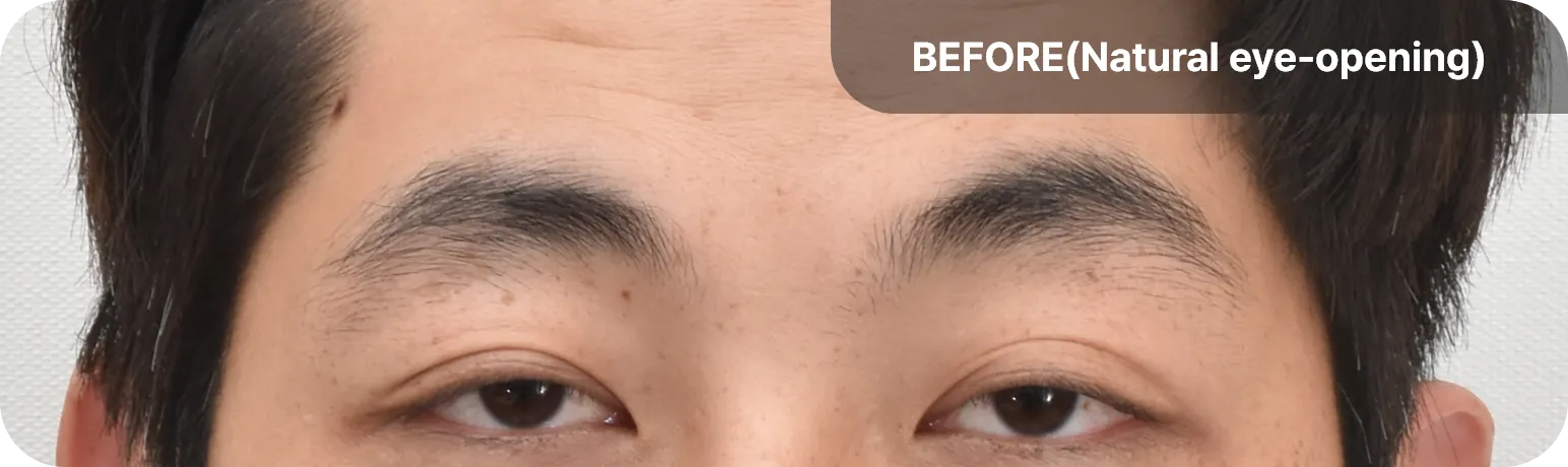 Appearance of droopy eyelids before surgery - noticeable drooping eyelids causing a fatigued and tired look