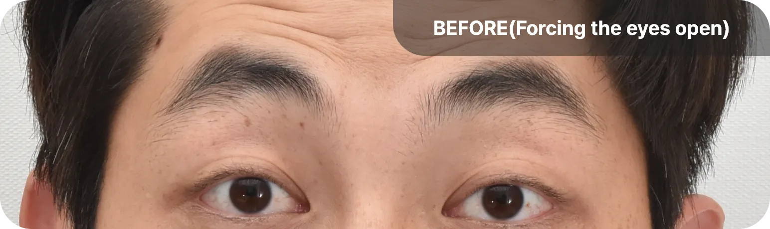 Droopy eyelids before surgery - forcing eyes open to achieve a normal appearance