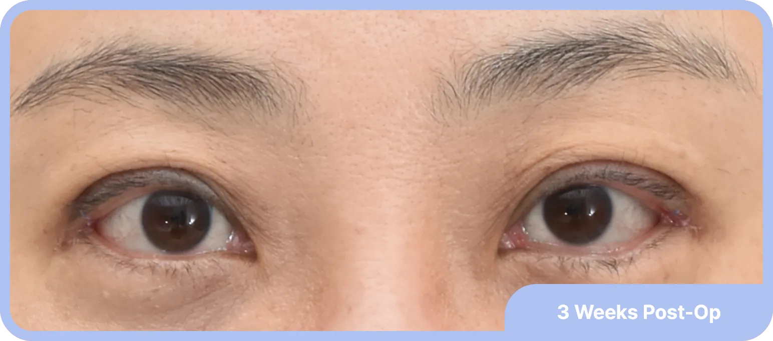 3 weeks post-Op ptosis surgery