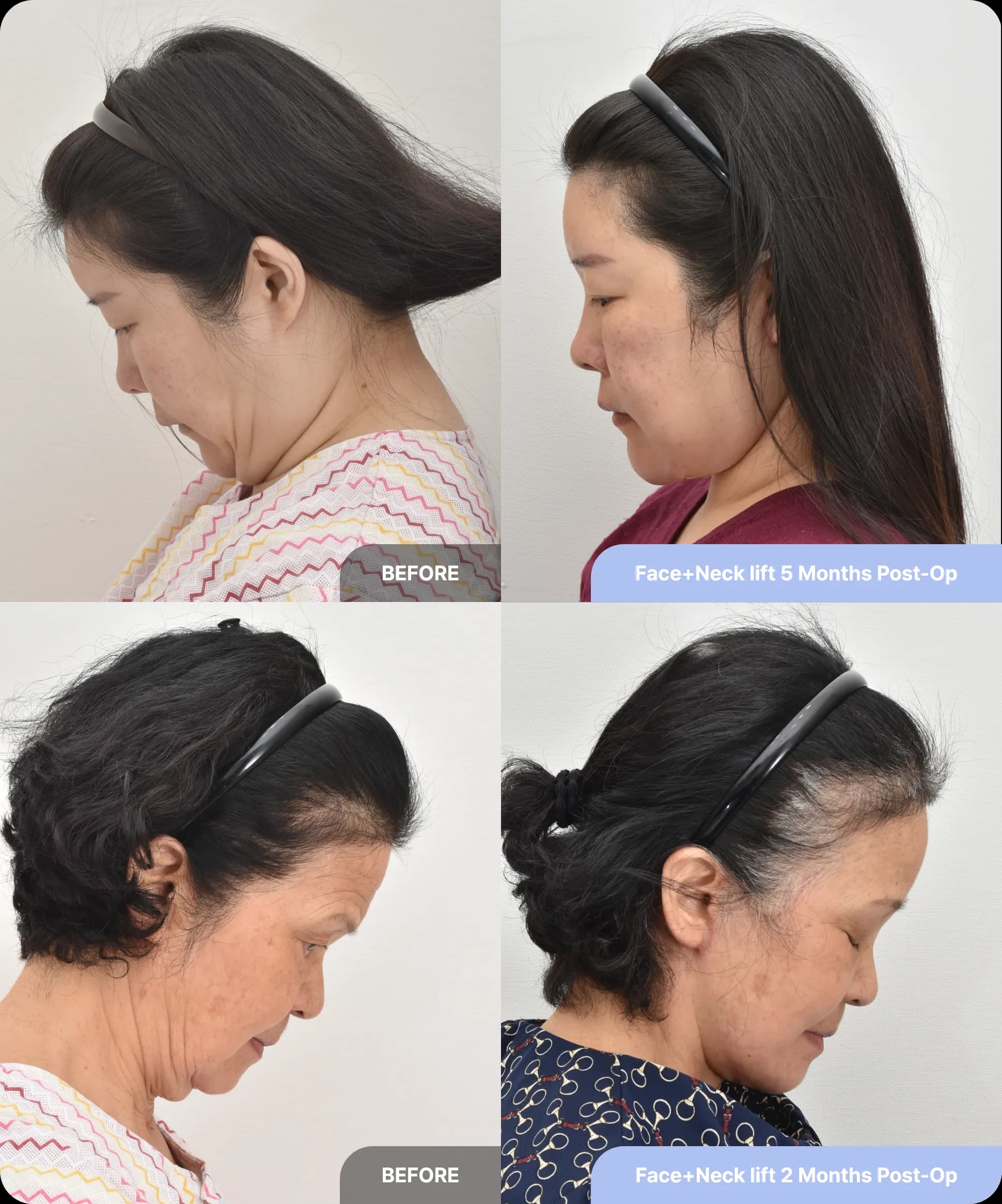 Neck lift results - firm, youthful neck with reduced wattles and fatty tissue