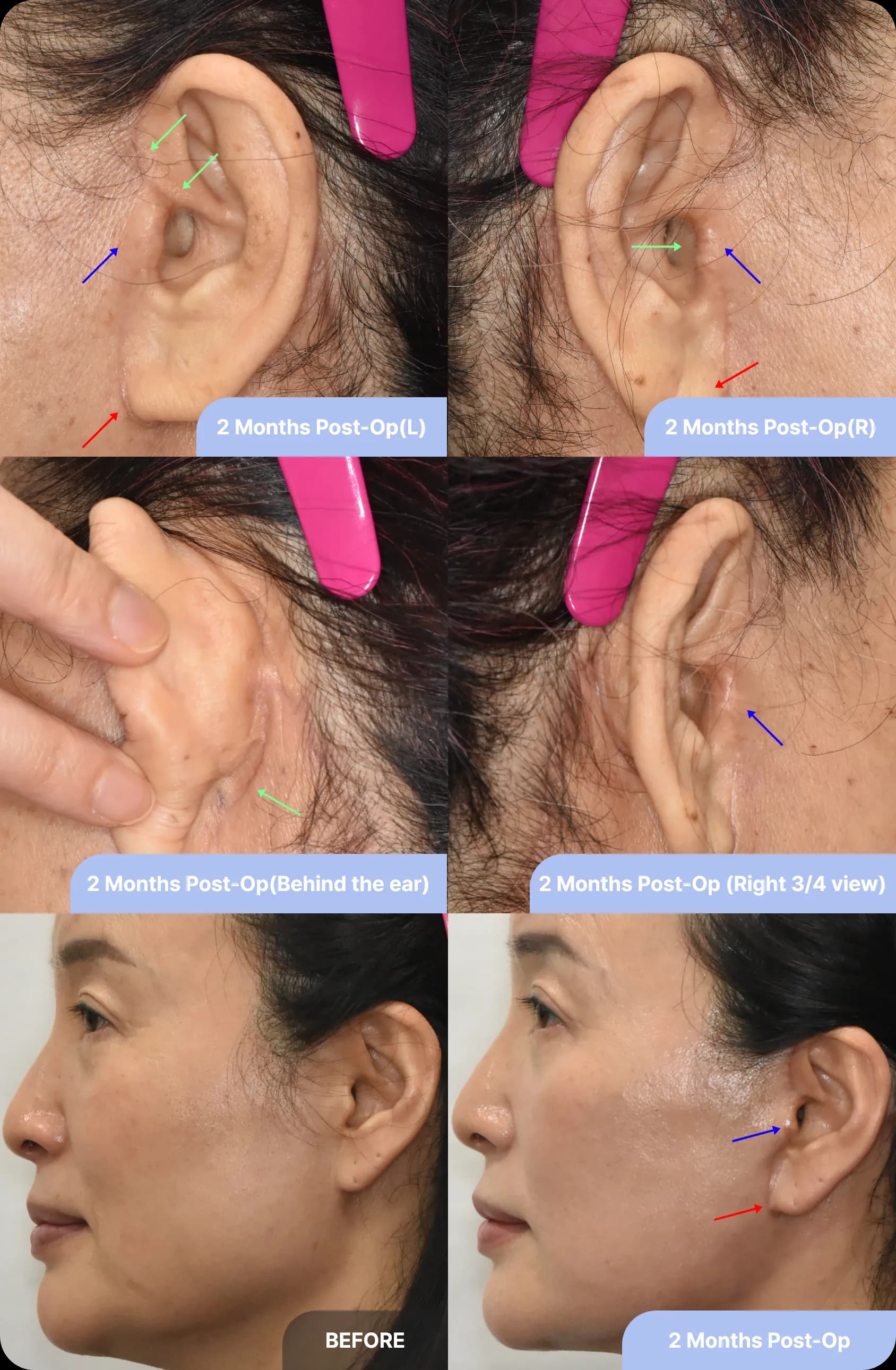 Unique features of Noonopi's facelift - 1. invisible scars and natural ear contours for a youthful look