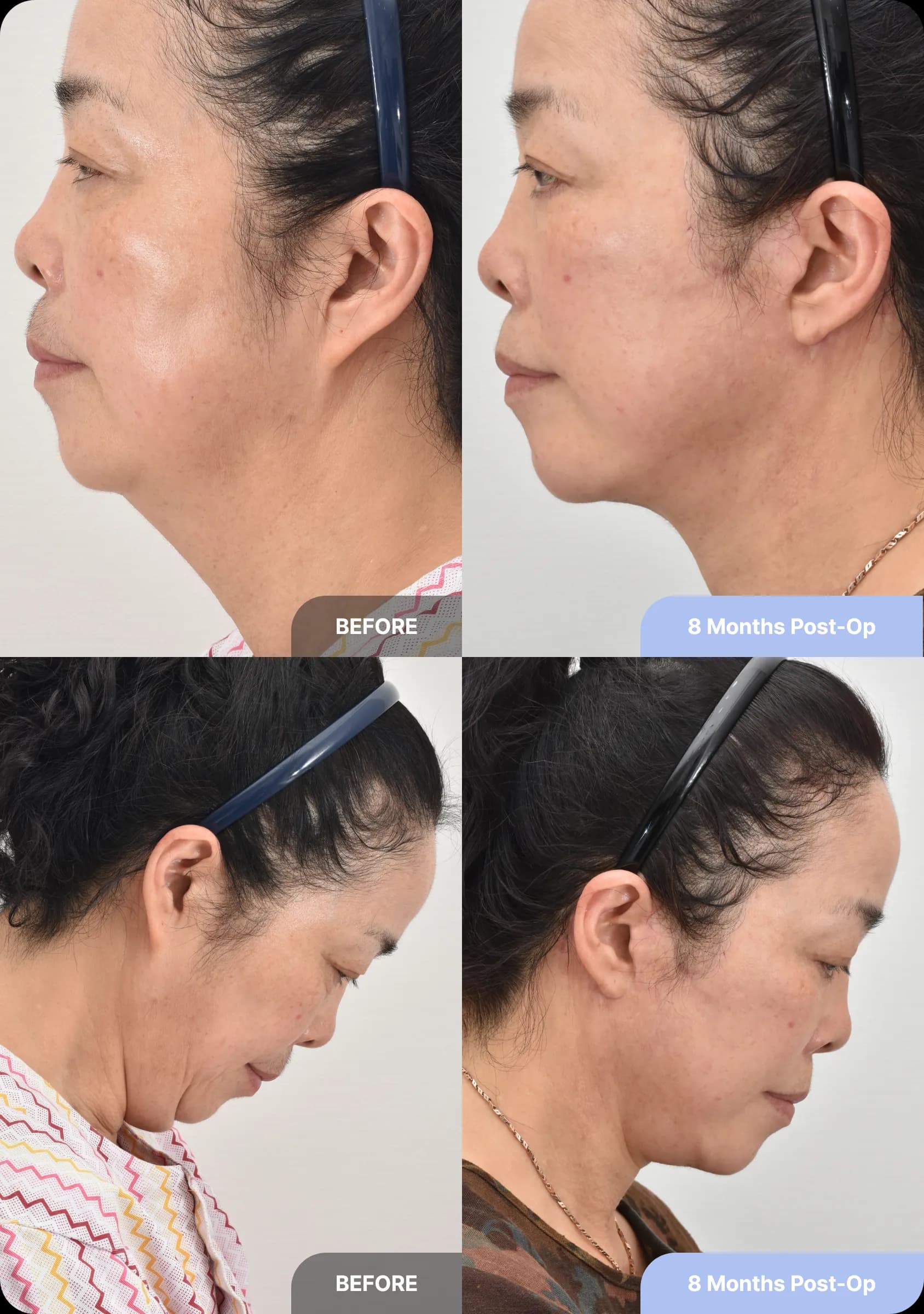 Unique features of Noonopi's facelift - 2. sideburns well preserved and earlobes expertly tailored for natural results
