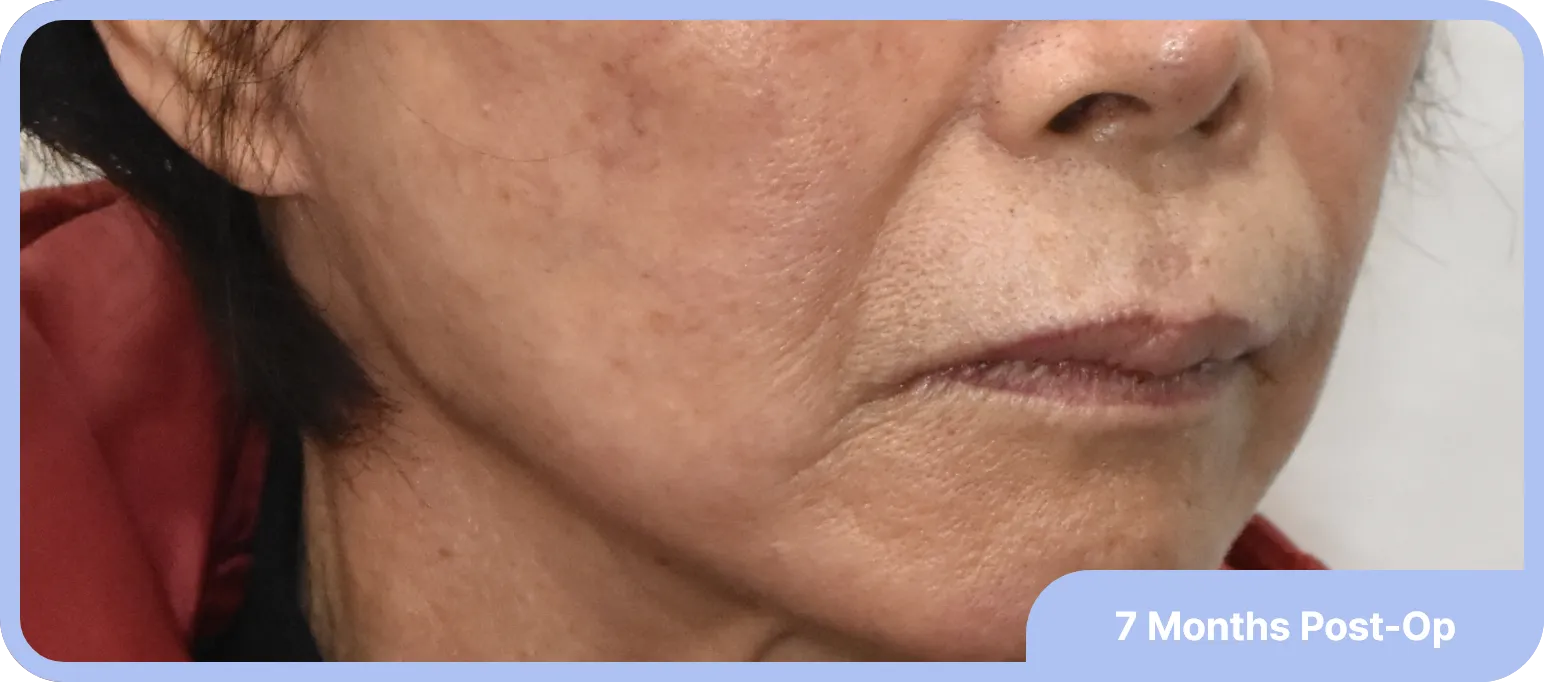 Unique features of Noonopi's facelift - 3. pixie ear are well corrected