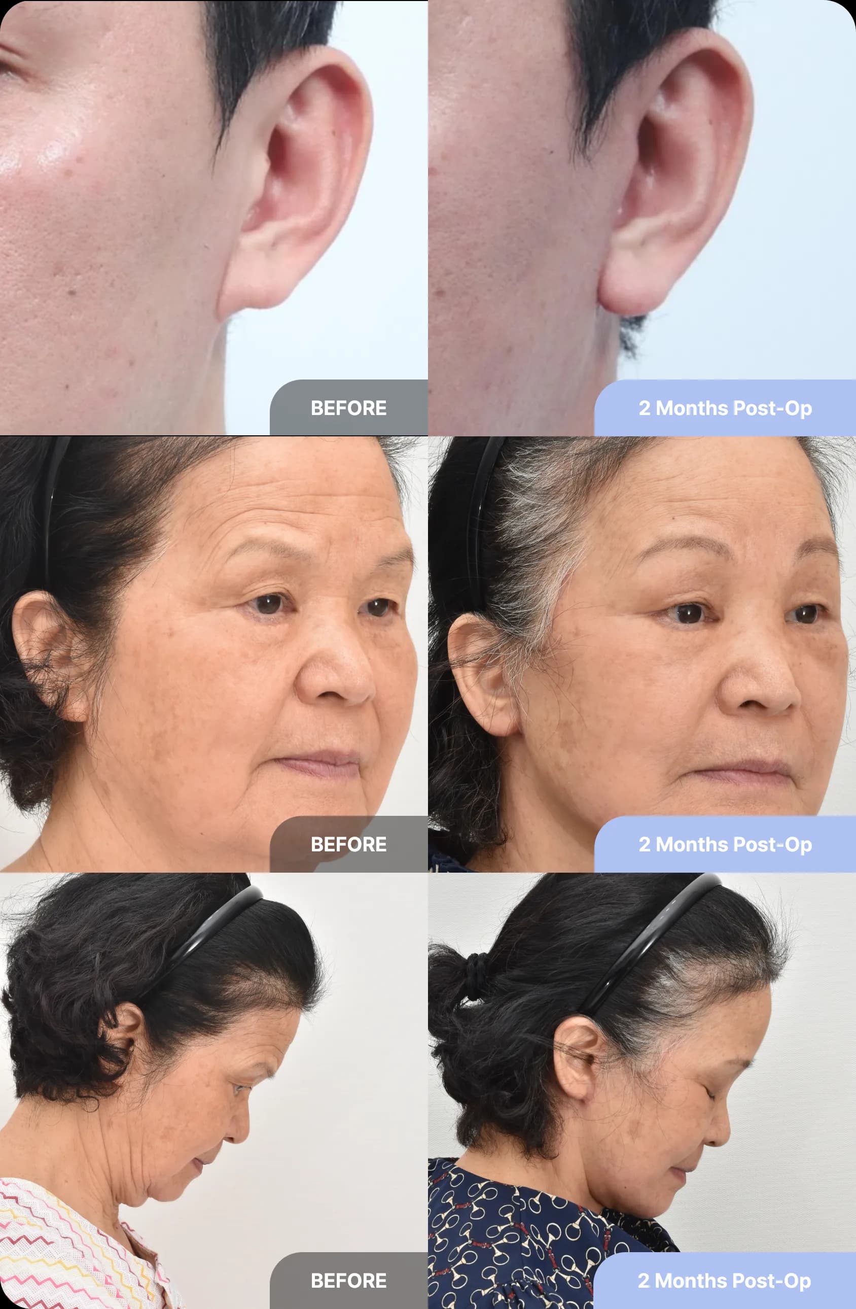 Unique features of Noonopi's facelift - 4. youthful earlobe