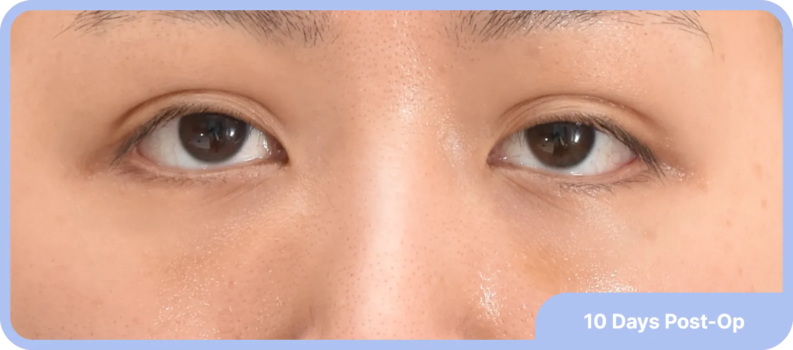 10 days after fat graft - more youthful eyelid