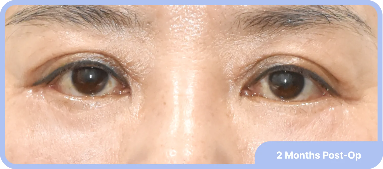 Lower lid fat graft and secondary lower blepharoplasty - restoring a youthful under-eye appearance