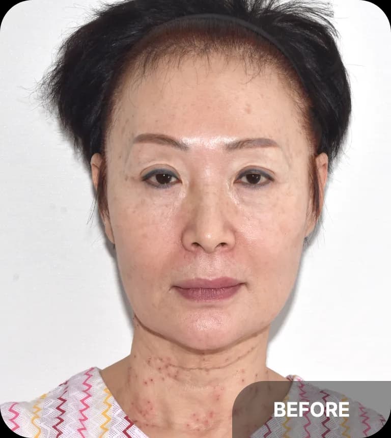 Before fat grafting - severe hollowing on the temple and lower eyelid area