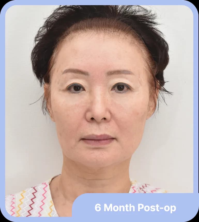 After fat grafting - restored volume in the temple and under-eye area