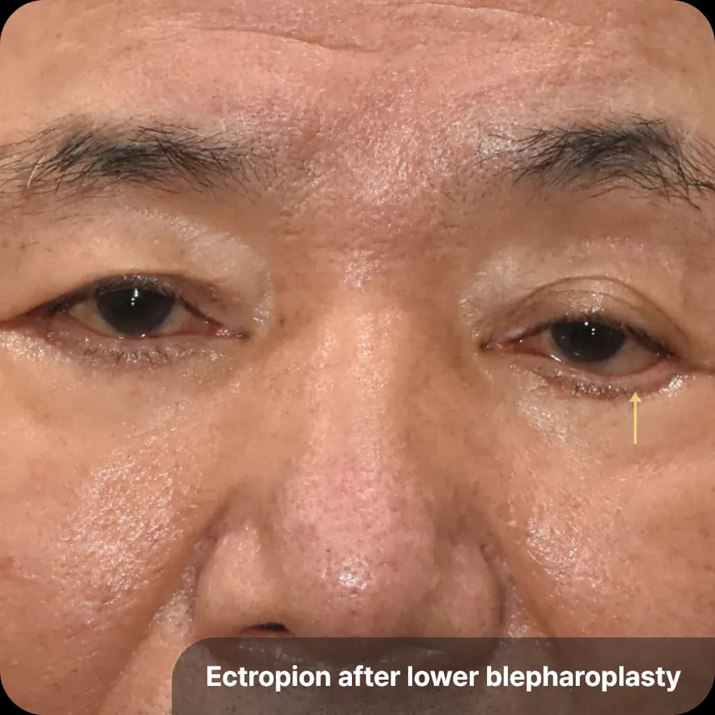 lower eyelid surgery complication - ectropion