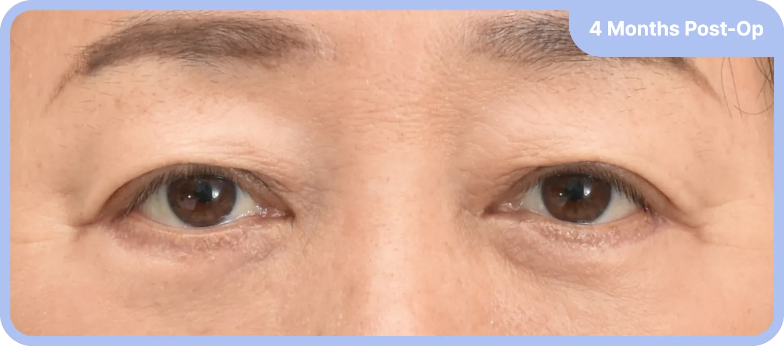 Lower blepharoplasty before and after - natural under-eye contouring