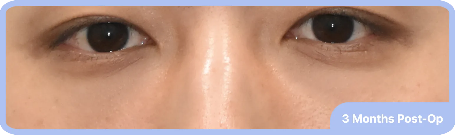 After dark circle treatment - reduced puffiness and even skin tone