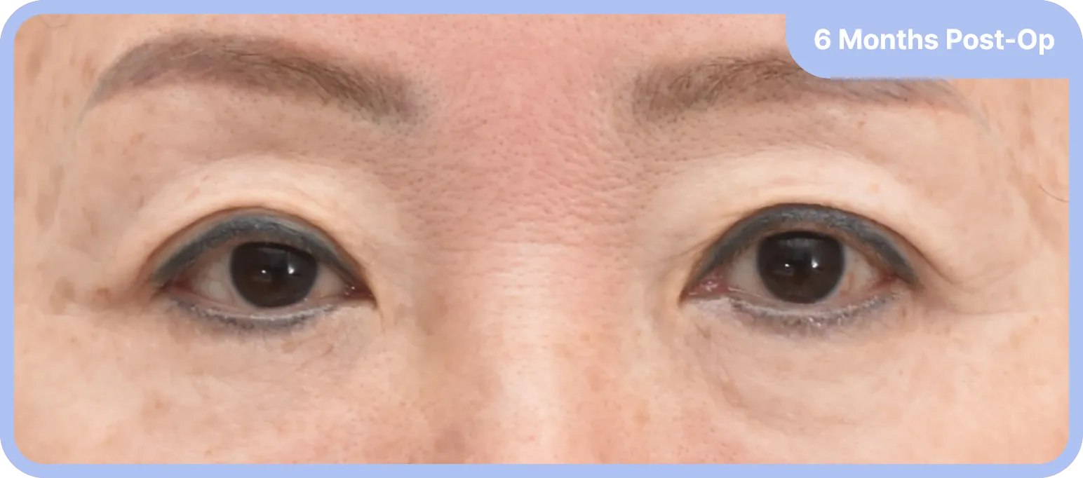 After eyelid lift surgery - sagging eyelids and hollowness correction